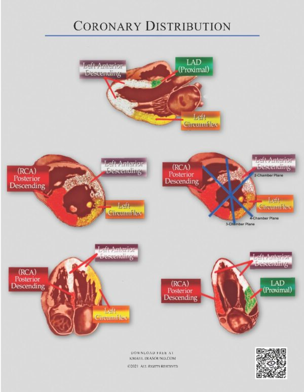 Coronary Artery Distribution and Echocardiography Wall Segments